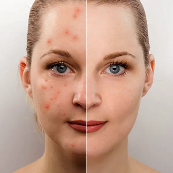Close-up of facial acne scars