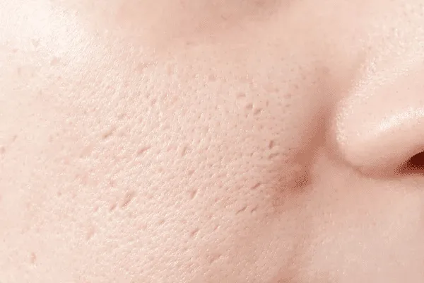 Atrophic acne scars on face showing