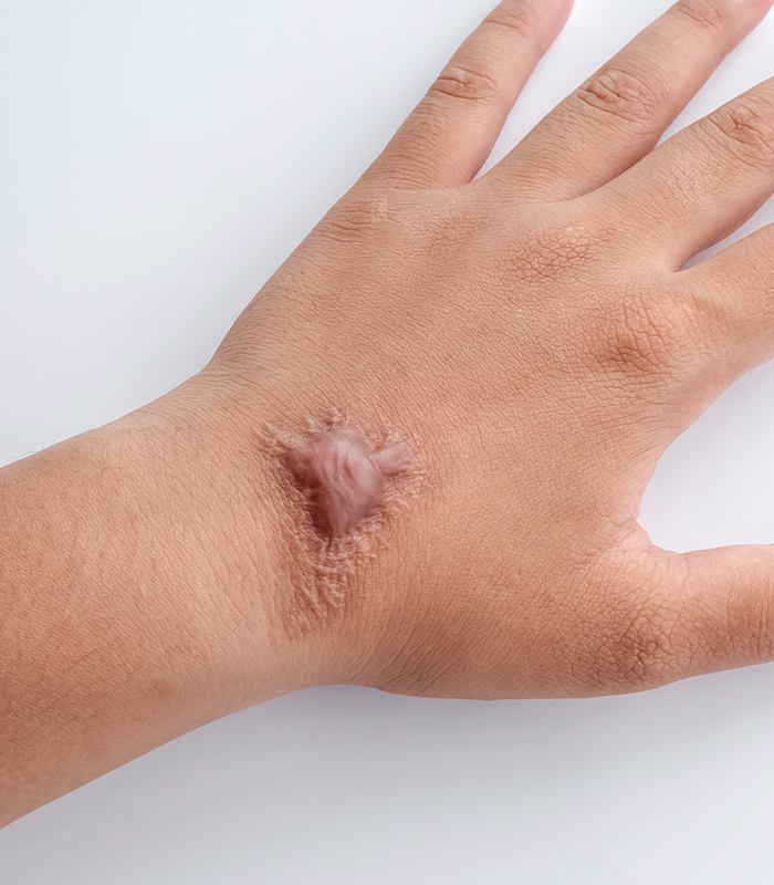 Hypertrophic keloid scar on hand treated